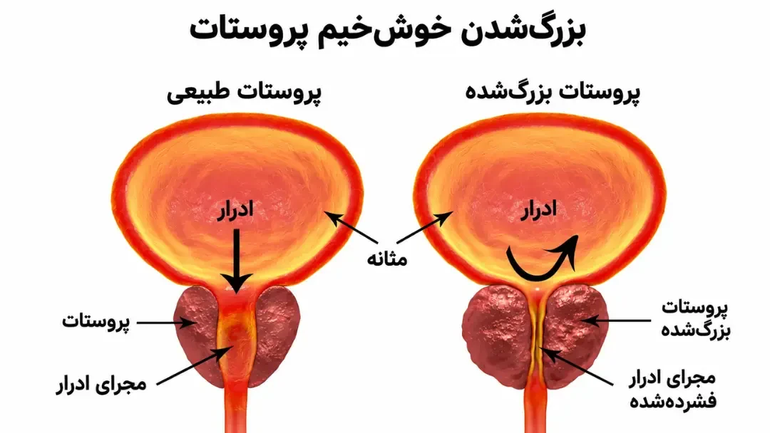 مقایسه ساختار پروستات طبیعی و پروستات بزرگ‌شده در کنار مثانه