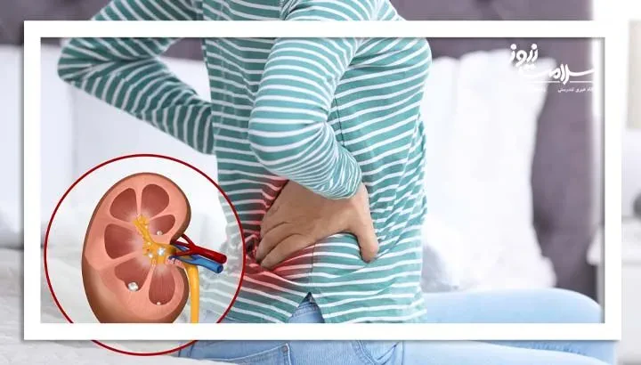 مصرف بیش از حد چای سرد و آب گریپ فروت خطر سنگ کلیه را افزایش می دهد
