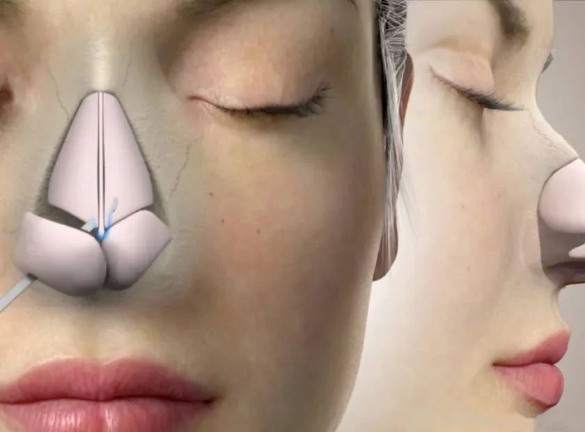 چگونه جراح بینی را انتخاب کنیم؟ 7 معیار مهم قبل از رینوپلاستی